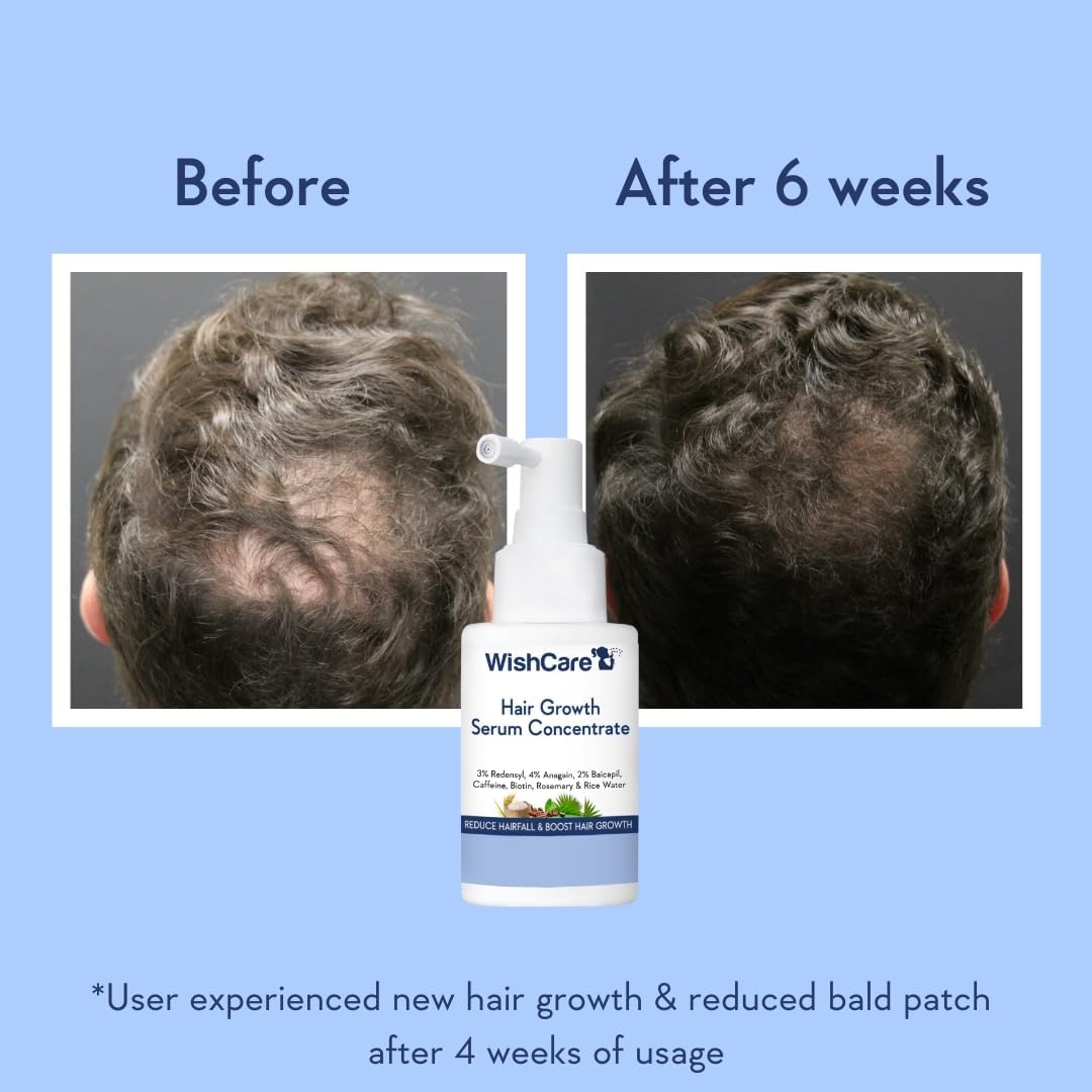 WishCare Hair Growth Serum with Rosemary, Redensyl, Anagain, Baicapil, Caffeine, Biotin