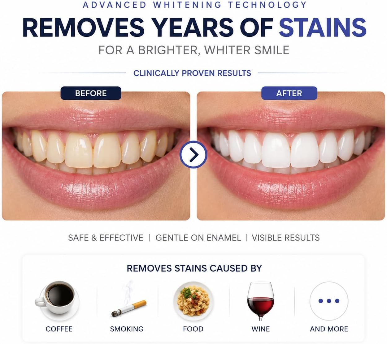 LUNAR Teeth Whitening Strips, 28 Strips, Enamel Safe, Non Sensitive Formula, Non Slip, Removes Coffee, Wine & Smoking Stains,14 Day Treatment