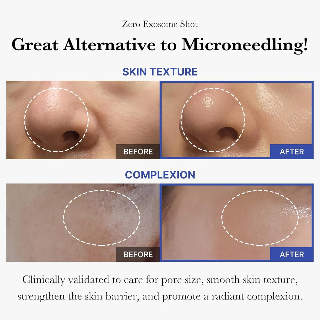 medicube Exosome Shot Zero 2,000 PPM Spicule Facial Serum | Liquid Skin Booster Serum | Exosome, AHA+BHA+PHA | Pore Care, Dead Skin Cells, Skin Texture | Korean Skincare, 1.01 fl.oz Halalzen