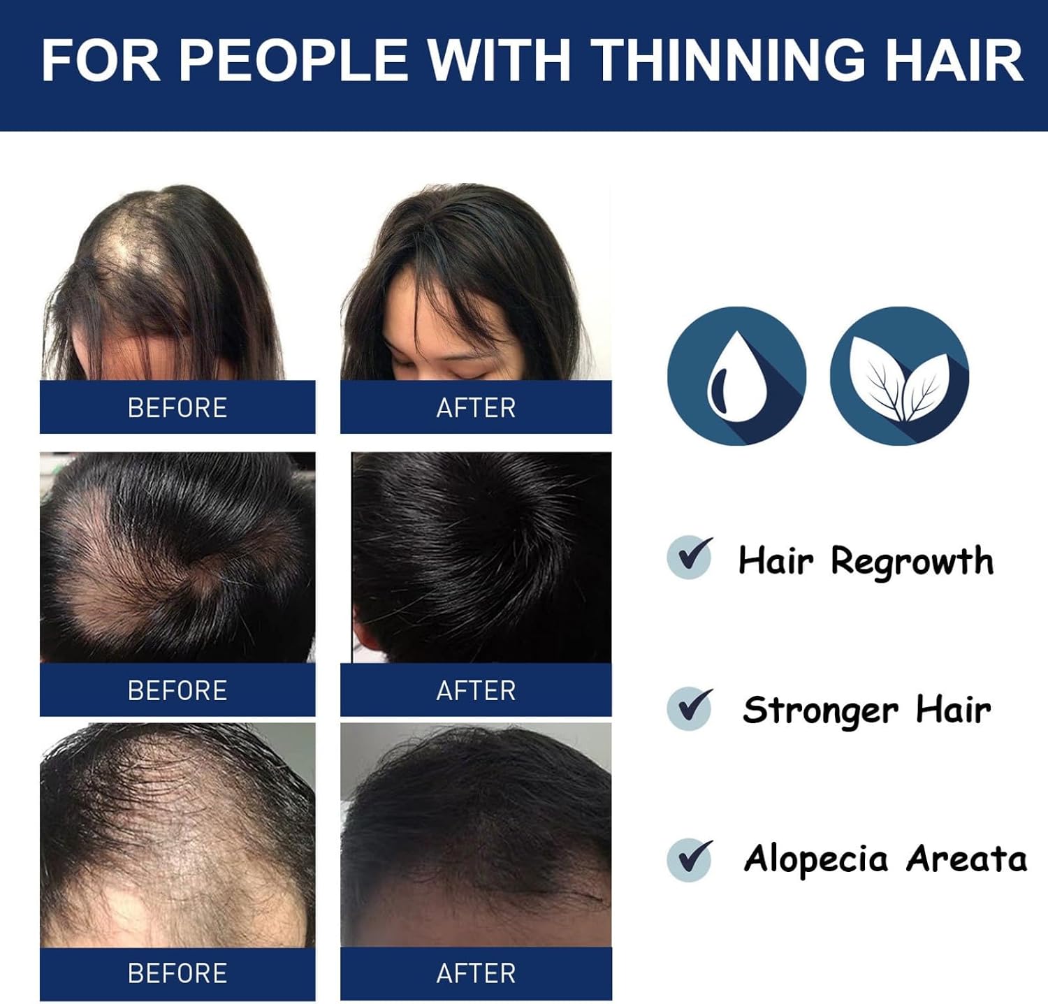Alopecia Ha-ir Growth Cream,H-air Los/s Treatment for Women,H-air Loss Treatment for Men,Rogaine H-air Regrowth Men，Scalp Nourishing Anti Hair Loss Serum,Hair Thinning,Scalp Moisturizer，20g