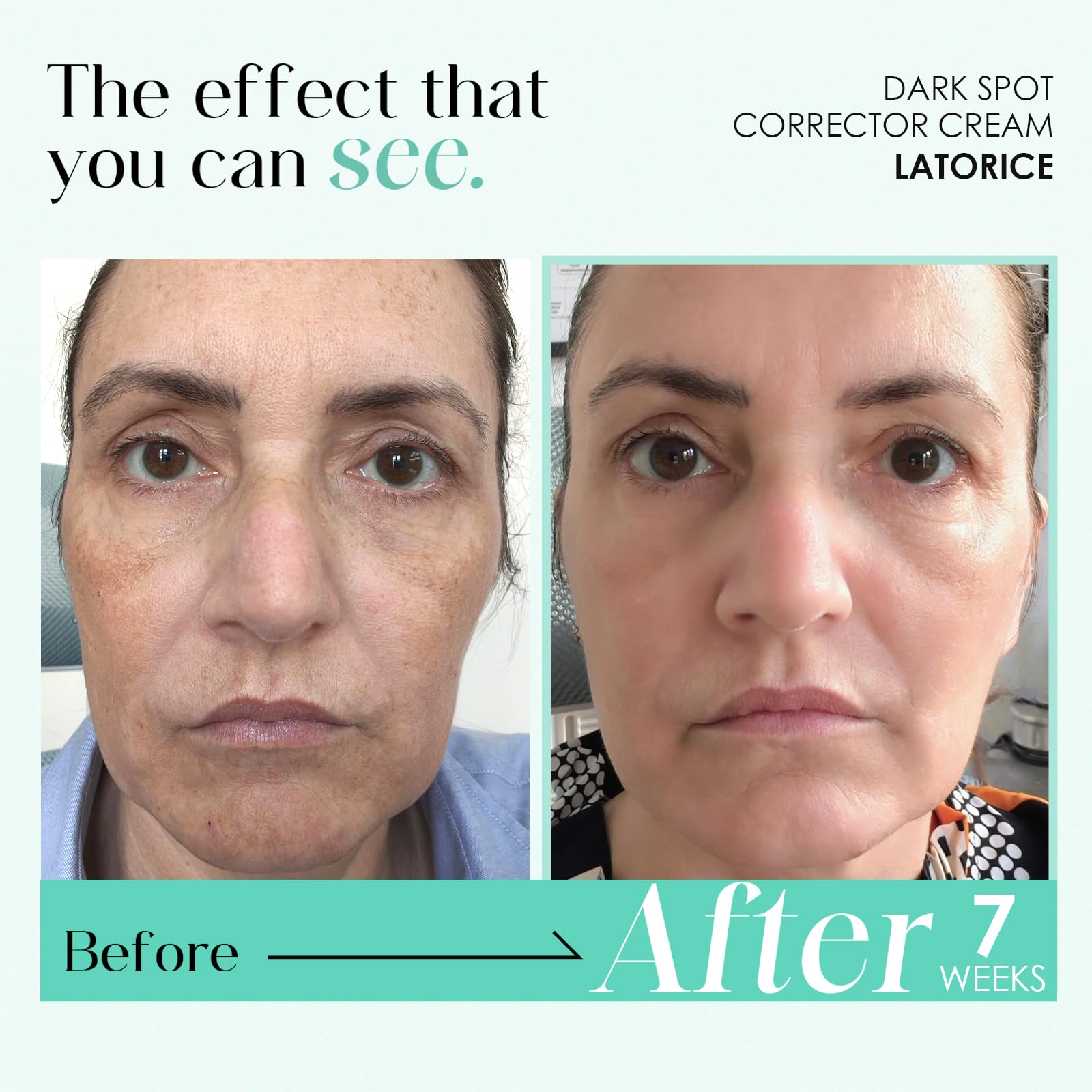 Dark Spot Remover for Face & Body: Dark Spot Corrector Cream for Sun Spot Melasma Freckles - Natural Ingredient Enriching Skin Care For women and men (50g) Halalzen