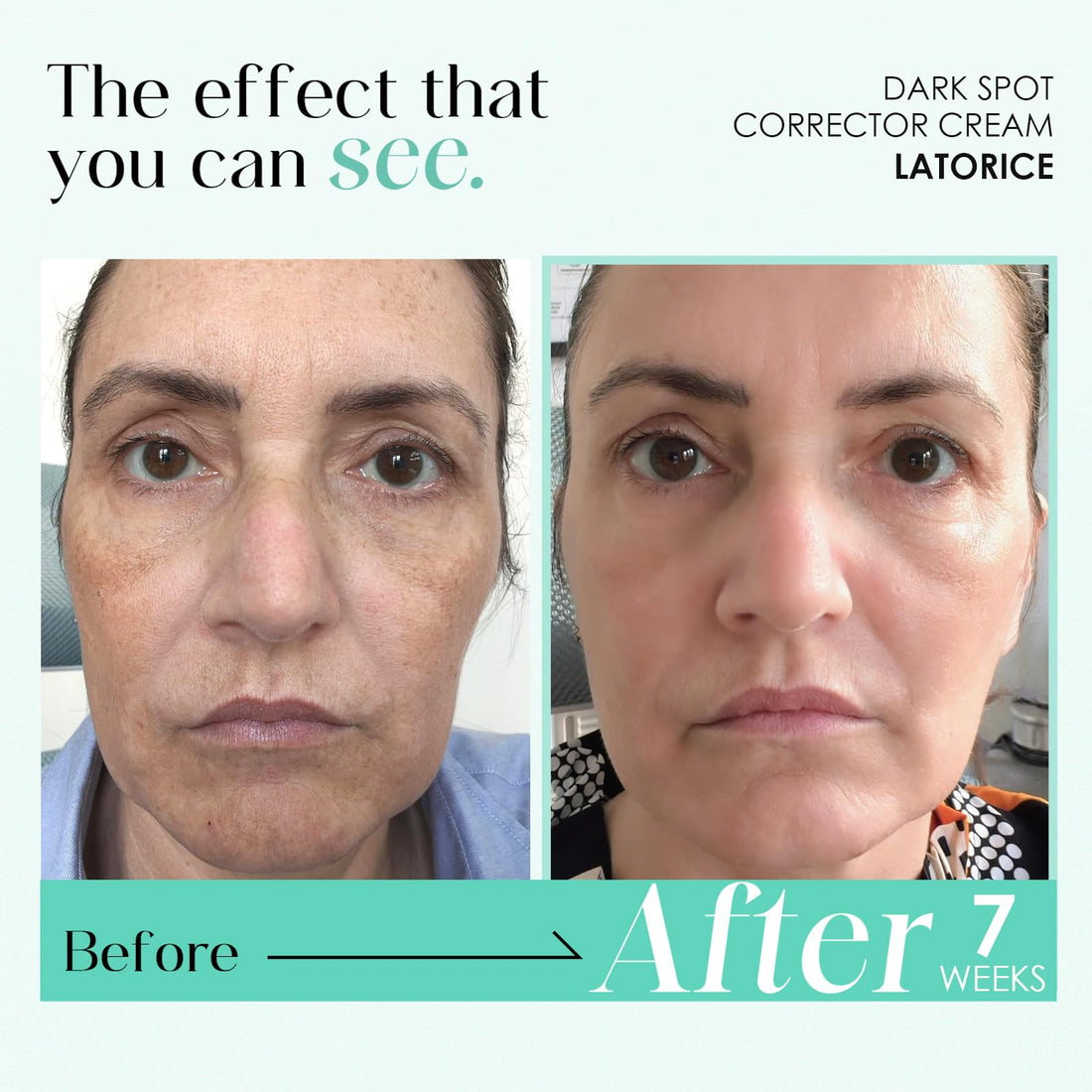 Dark Spot Remover for Face & Body: Dark Spot Corrector Cream for Sun Spot Melasma Freckles - Natural Ingredient Enriching Skin Care For women and men (50g) Halalzen