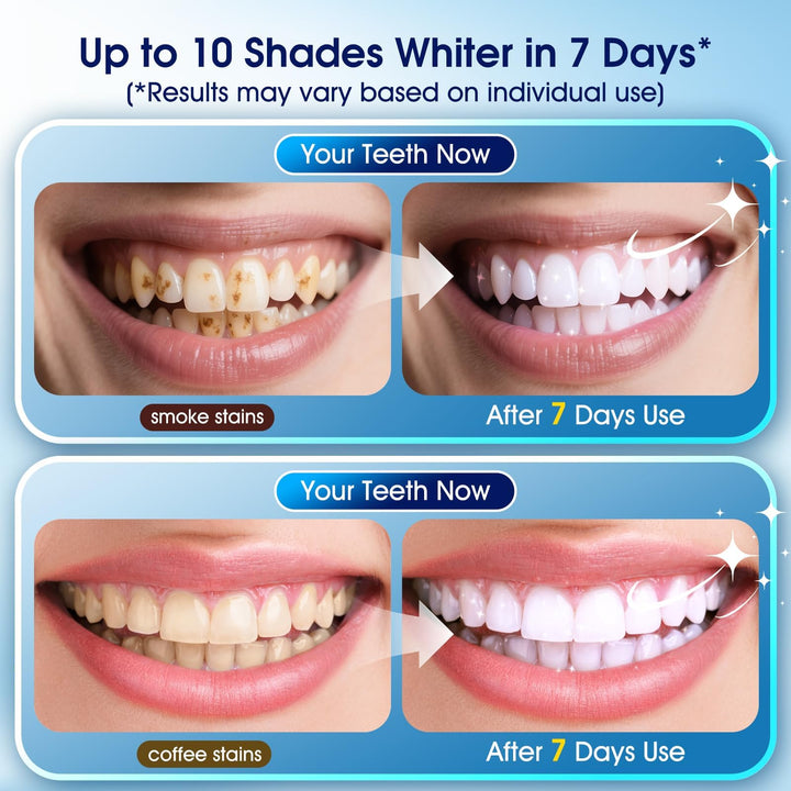 Teeth Whitening Kit with LED Light – 3 Teeth Whitening Gel Pens + 2 Remineralizing Desensitizing Gel Pens –35% Pap Whitening Formula – Whiten Teeth in 7 Days – Safe for Sensitive Teeth (Mint)
