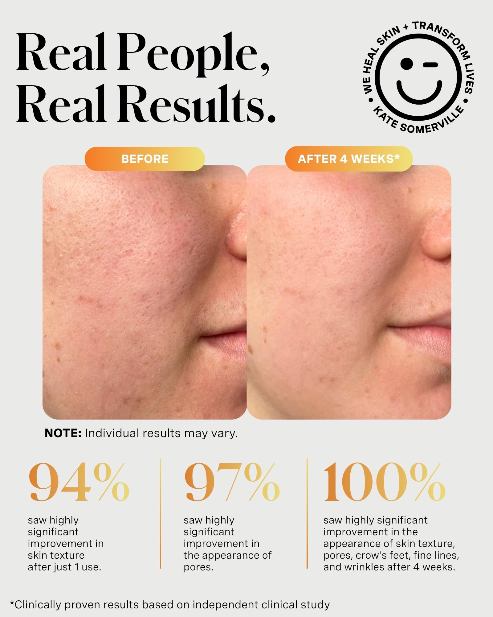 Kate Somerville ExfoliKate Intensive Exfoliating Treatment – Salicylic Acid and Lactic Acid Super Facial Scrub and Mask, Improves Texture and Pores