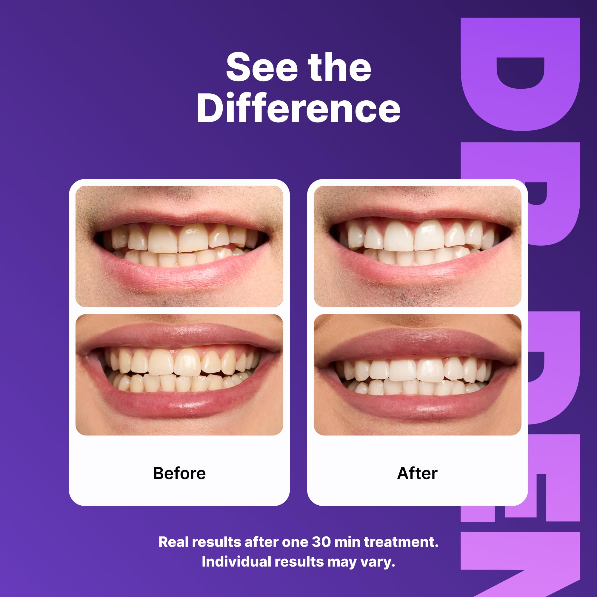 DRDENT Teeth Whitening Strips Professional Strength – 21 Treatments (42 Strips) with Mouth Opener – Enamel Safe Teeth Whitening Kit for Sensitive Teeth