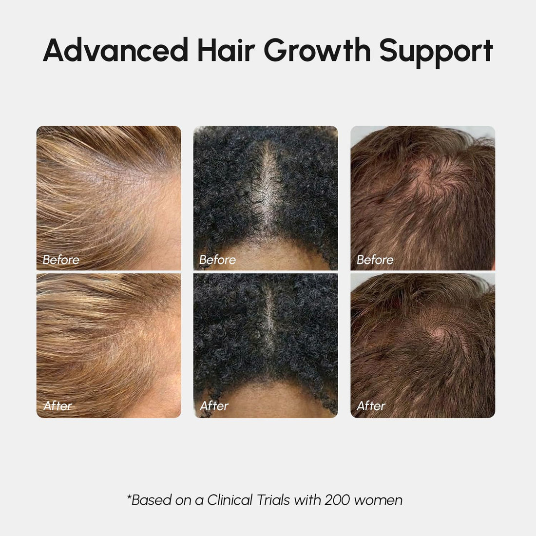 MAREE Haarwuchsserum - Koffeinpeptide Rizinus-Rosmarinöl für Haarwuchs - Produkte für Frauen & Männer - Haaröle für Haarwuchs - Haarwuchsmittel - Kopfhautserum - Suero Para El Cabello
