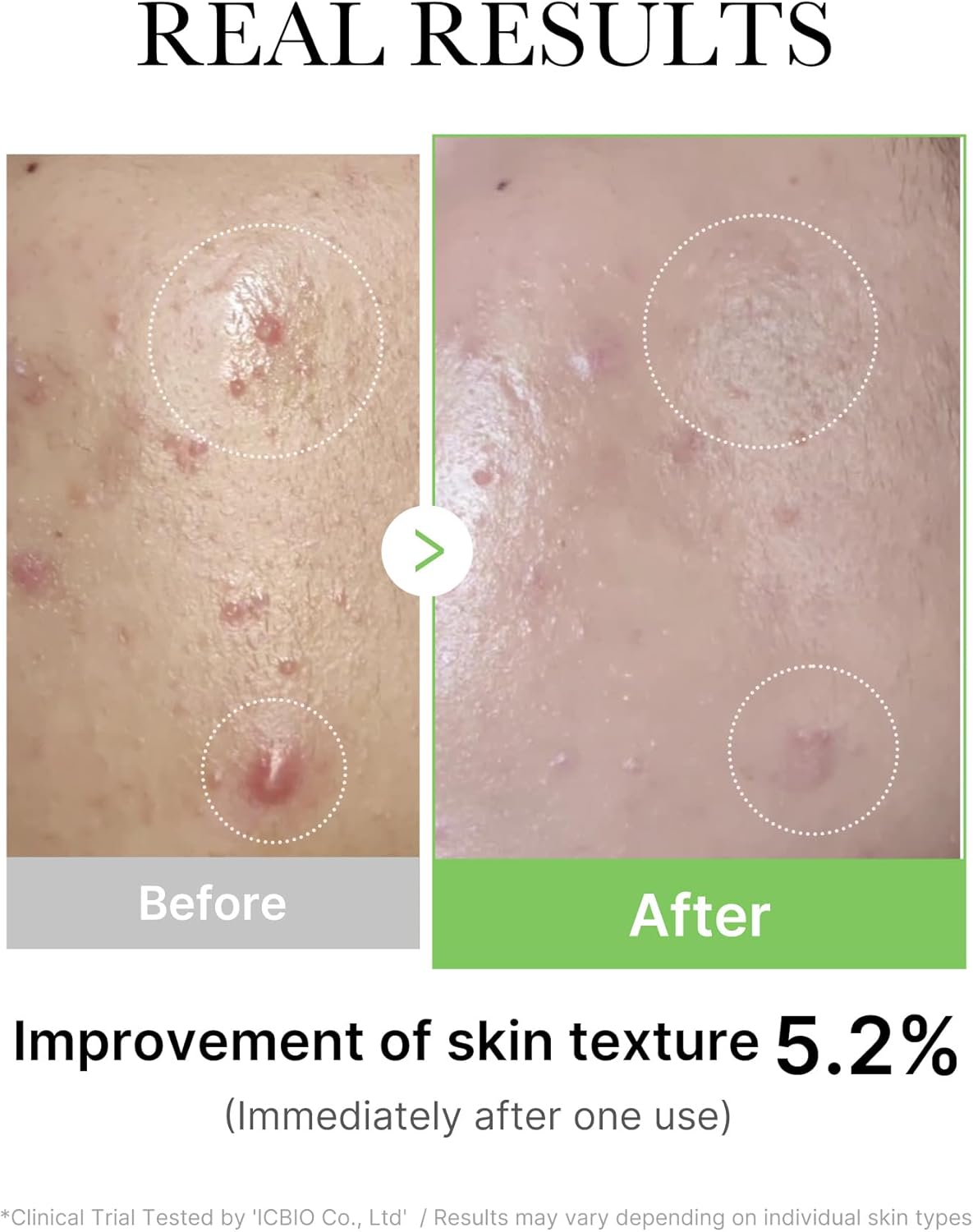 medicube Exosome Cica Tea Tree Ampoule for Sensitive Skin with Centella Asiatica - Helps Reduce Redness and Breakouts | Low-Irritating, Moisturizing & Soothing Serum | Korean Skincare | 30ml