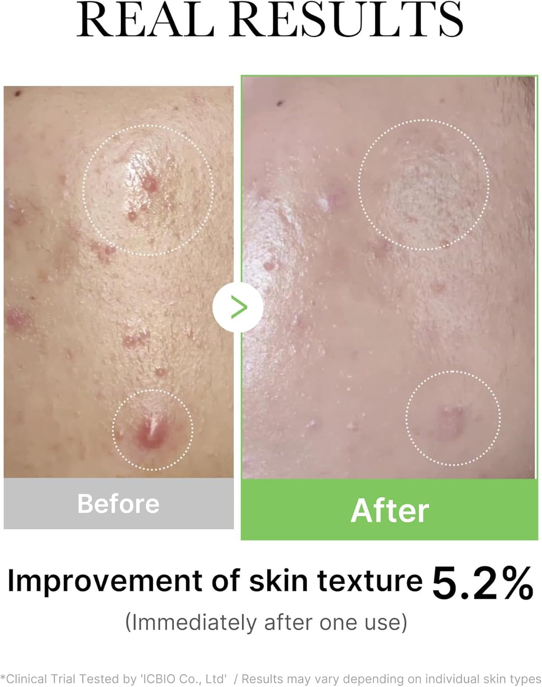 medicube Exosome Cica Tea Tree Ampoule for Sensitive Skin with Centella Asiatica - Helps Reduce Redness and Breakouts | Low-Irritating, Moisturizing & Soothing Serum | Korean Skincare | 30ml