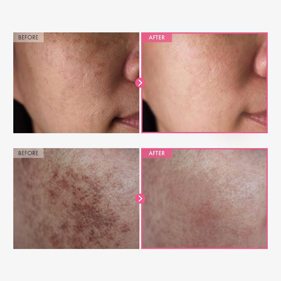 TOSOWOONG Arbutin 7% + Tranexamic Acid 4% Cream, 70,000ppm Arbutin, 40,000ppm TXA, Niacinamide, Glutathione, Dark Spots, Freckle, Blemishes, Pigmentation, Korean Skin Care, 50ml, 1.69 fl.oz. Halalzen