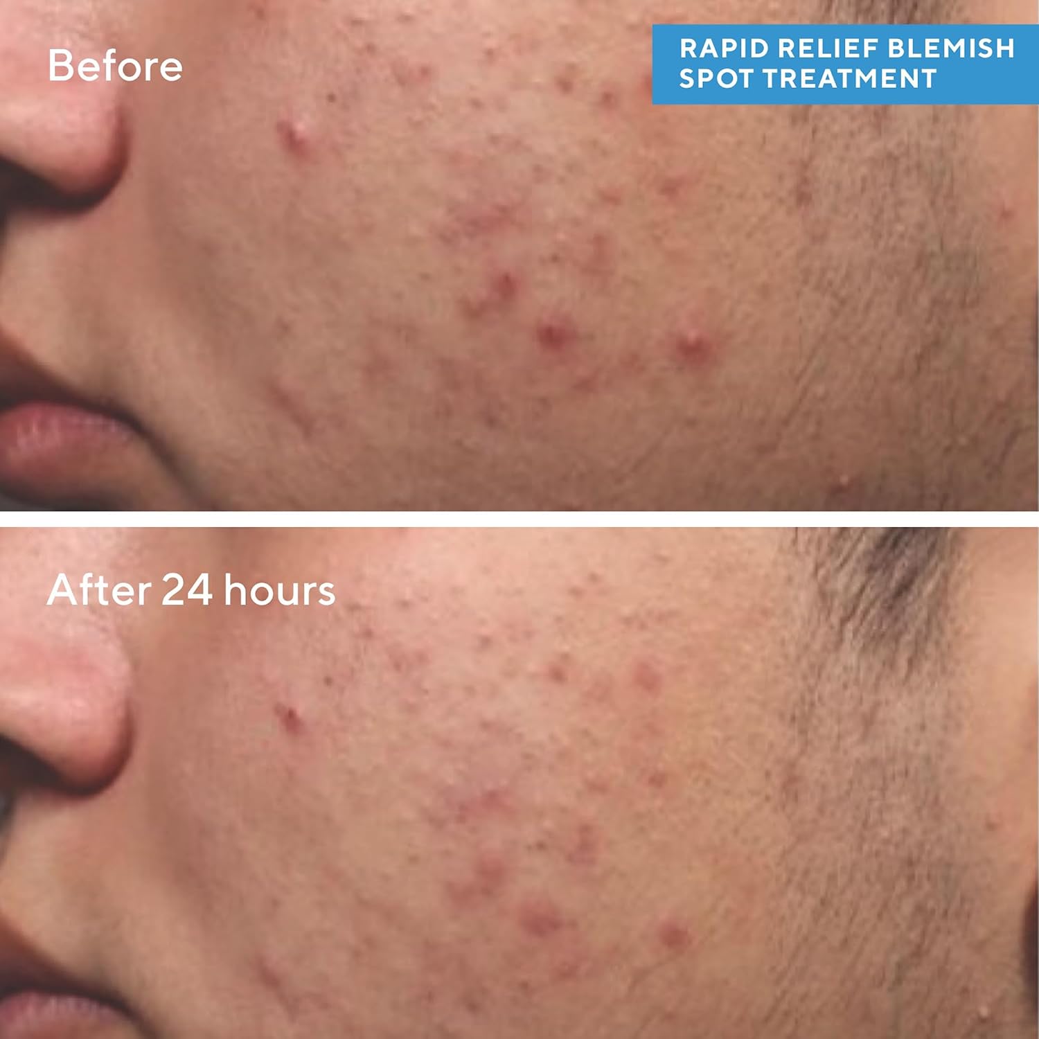 Murad Rapid Relief Spot Treatment - Blemish Control Max Strength 2% Salicylic Acid Gel - Fast Blemish Relief - Instant Blemish Spot Treatment - 15ml Clear Gel for Face Halalzen