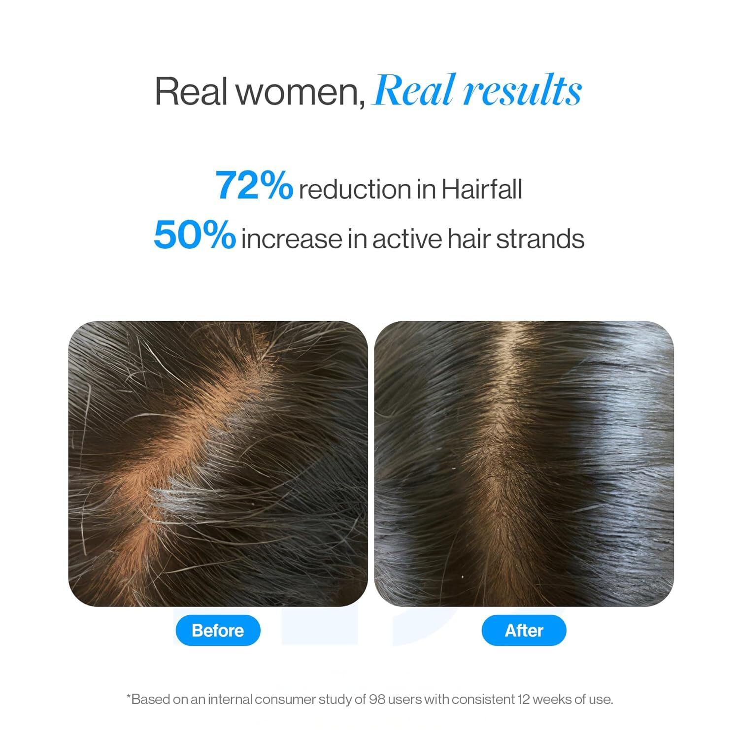 Be Bodywise Rosemary Hair Growth Serum (Roll On) | 3% Redensyl & 2% Anagain | Hair fall control serum for Women & Men | Promotes Hair Growth & Stimulates Hair Follicles | For All Hair Types | 25ml