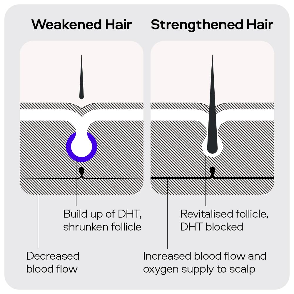 Sons Minoxidil 5% Spray for Men (1x60ml), Clinically Proven Hair Regrowth & Thickening Formula, Anti-Hair Loss Treatment, Stimulates Follicles, Easy to Use Precision Application System, Made in Europe