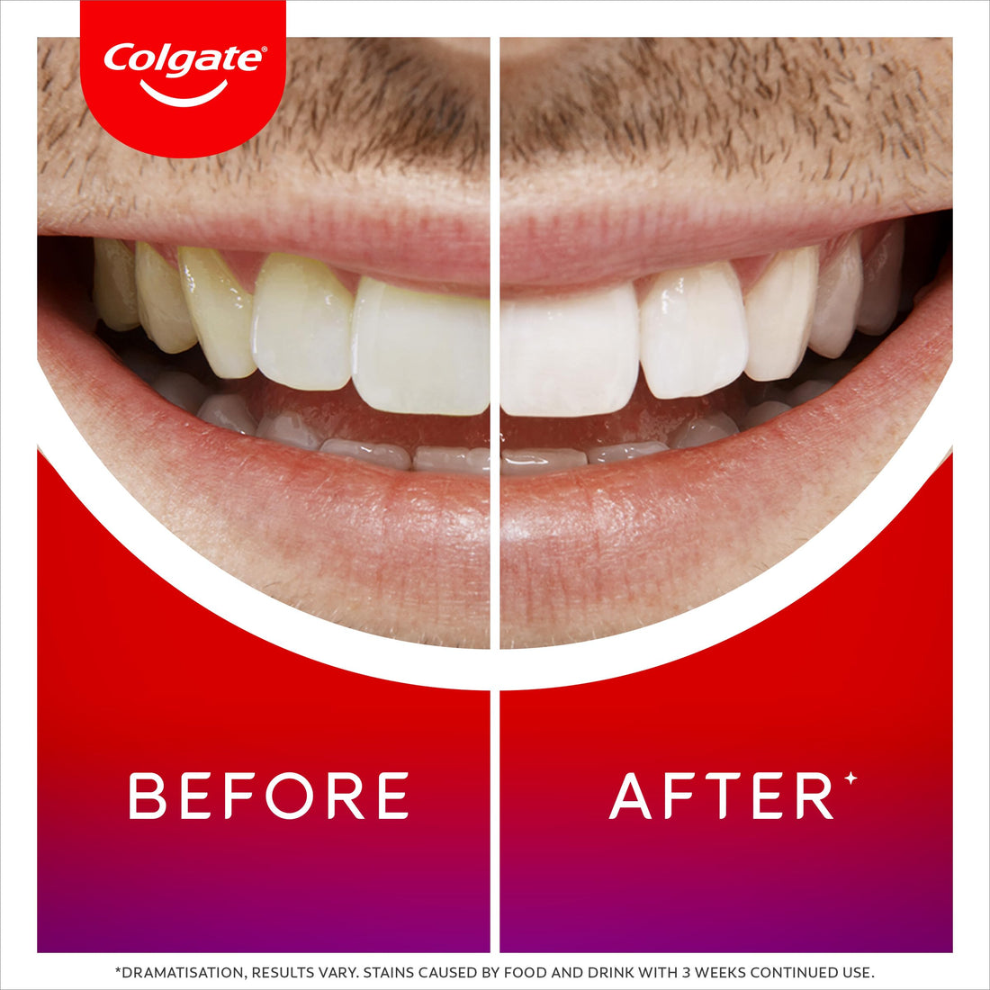 Colgate Max White Ultra+ Enamel Toothpaste 75ml, Whitens Deep Stains for 5X Whiter Teeth, ActiveShine Technology Smoothes Enamel Surface to Reflect Light, Protects and Remineralises Enamel