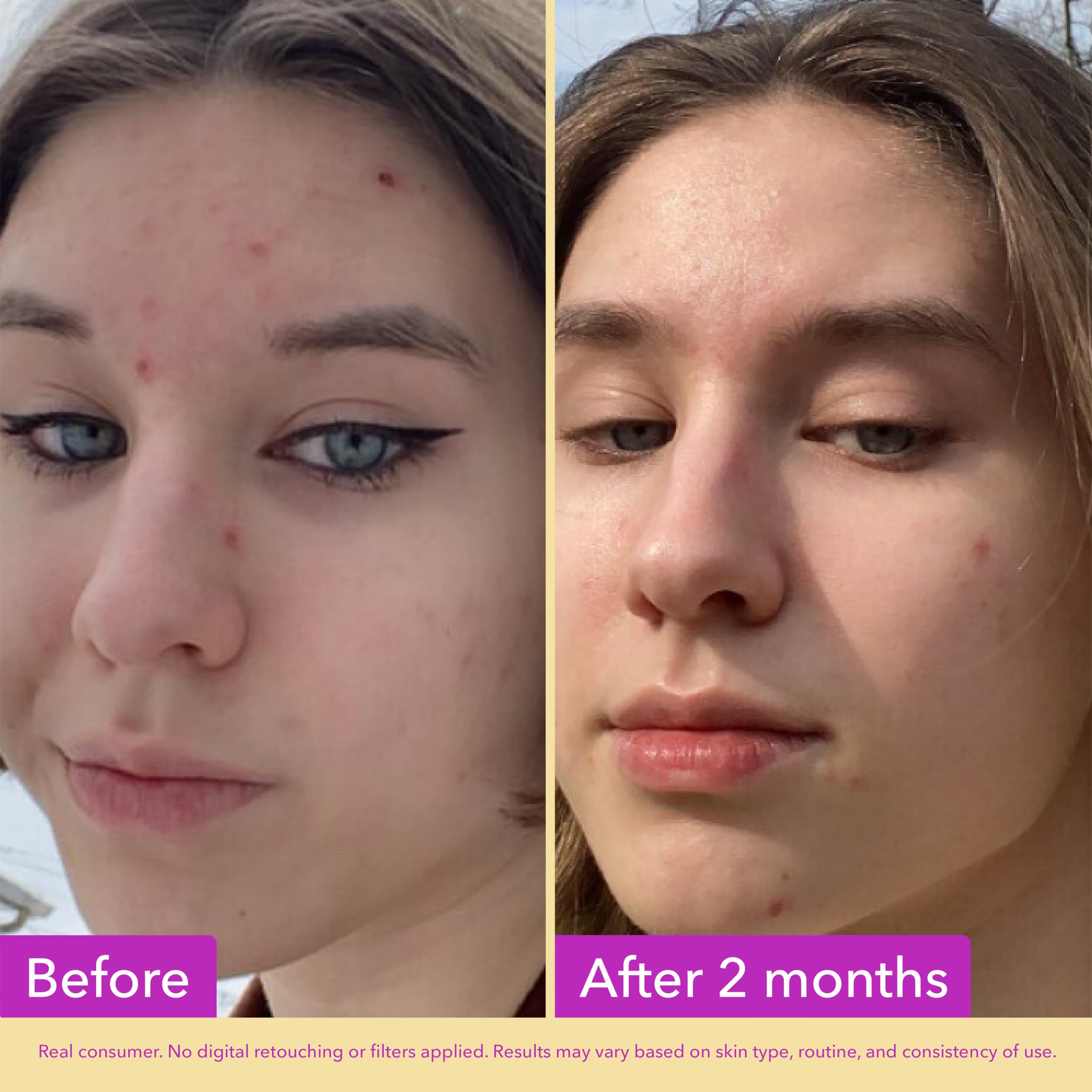 Good Molecules Niacinamide Serum - 10% Niacinamide Balancing B3 Facial Serum For Acne, Tone, Texture - Brightening And Hydrating Skincare For Face