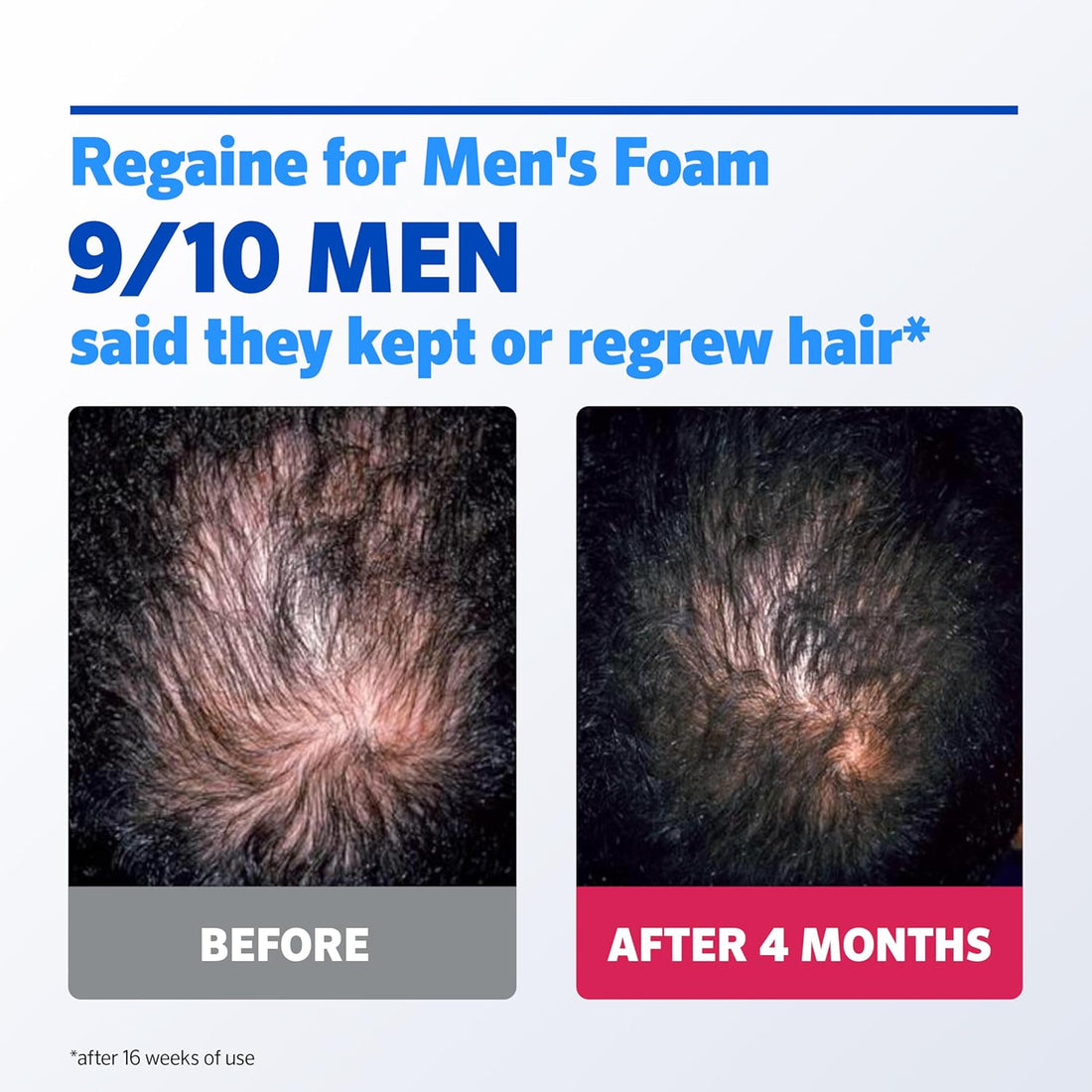Regaine For Men Extra Strength Foam - Scientifically Proven To Help Stop Hereditary Hair Loss - Minoxidil Foam for Hair Regrowth - 73ml, Packaging may vary