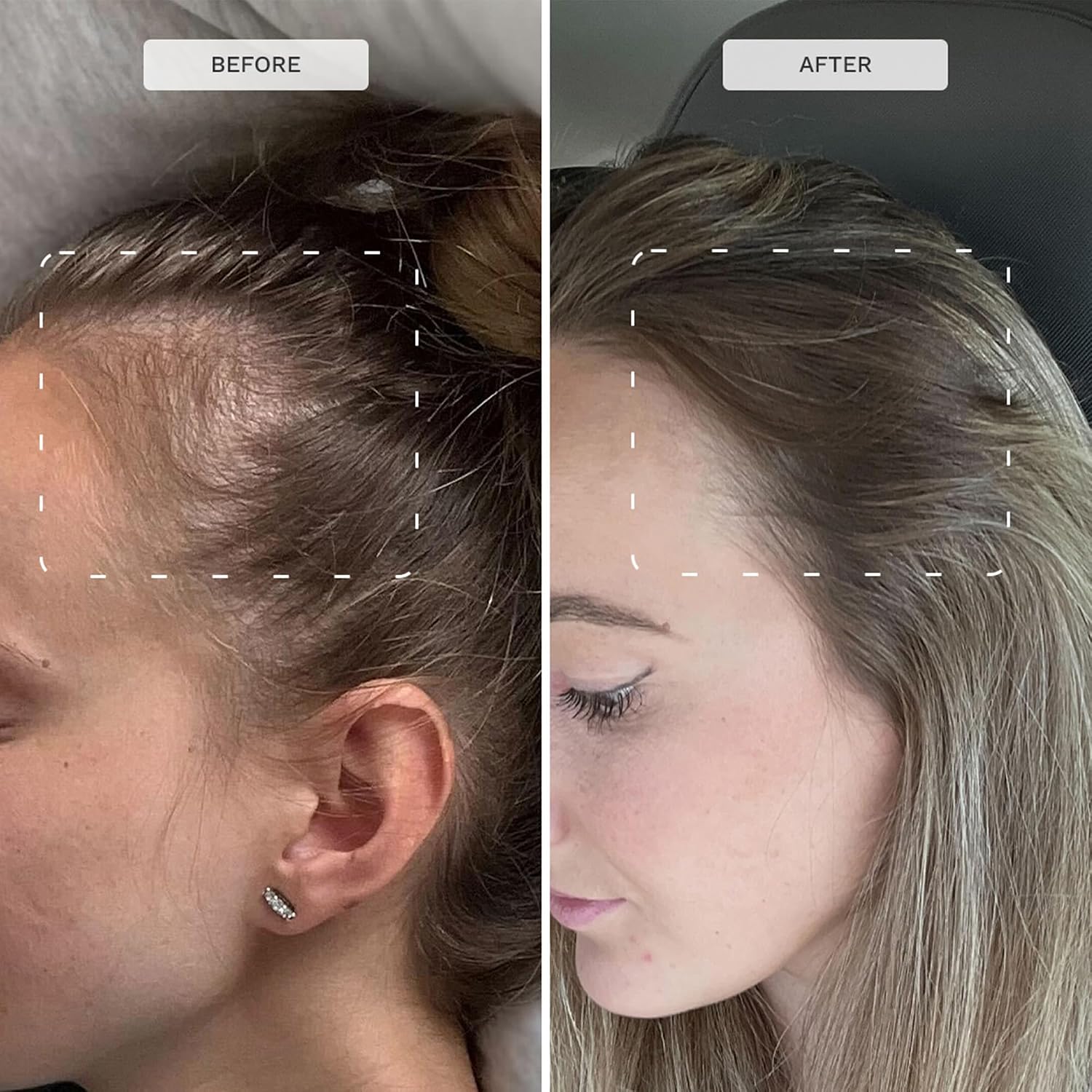HAIR BURST Biotin Hair Vitamins - Safe for Pregnancy, Breastfeeding & Postpartum - Hair Loss Supplement to Essential for new Mums - Contains Zinc, B Vitamins & Folic Acid (30 Day Supply)