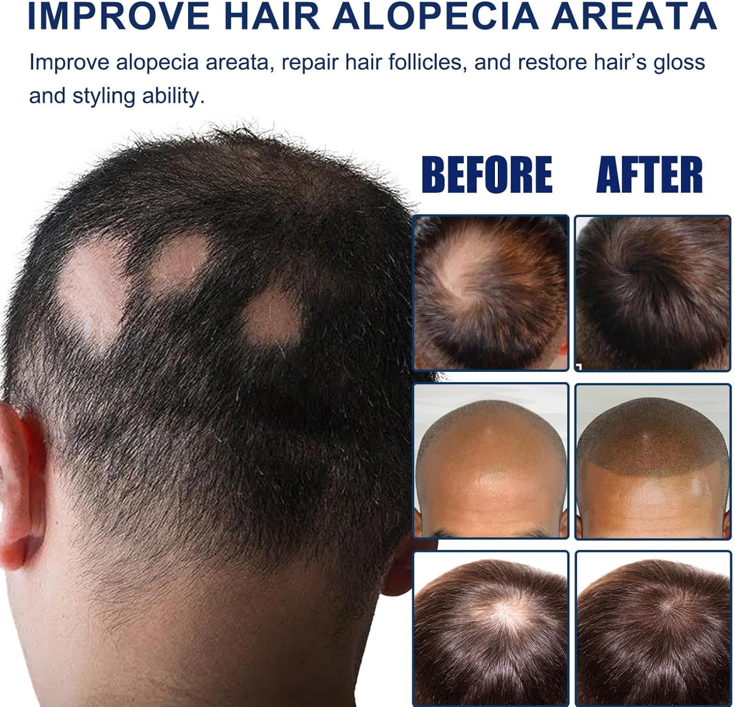 Alopecia Ha-ir Growth Cream,H-air Los/s Treatment for Women,H-air Loss Treatment for Men,Rogaine H-air Regrowth Men，Scalp Nourishing Anti Hair Loss Serum,Hair Thinning,Scalp Moisturizer，20g