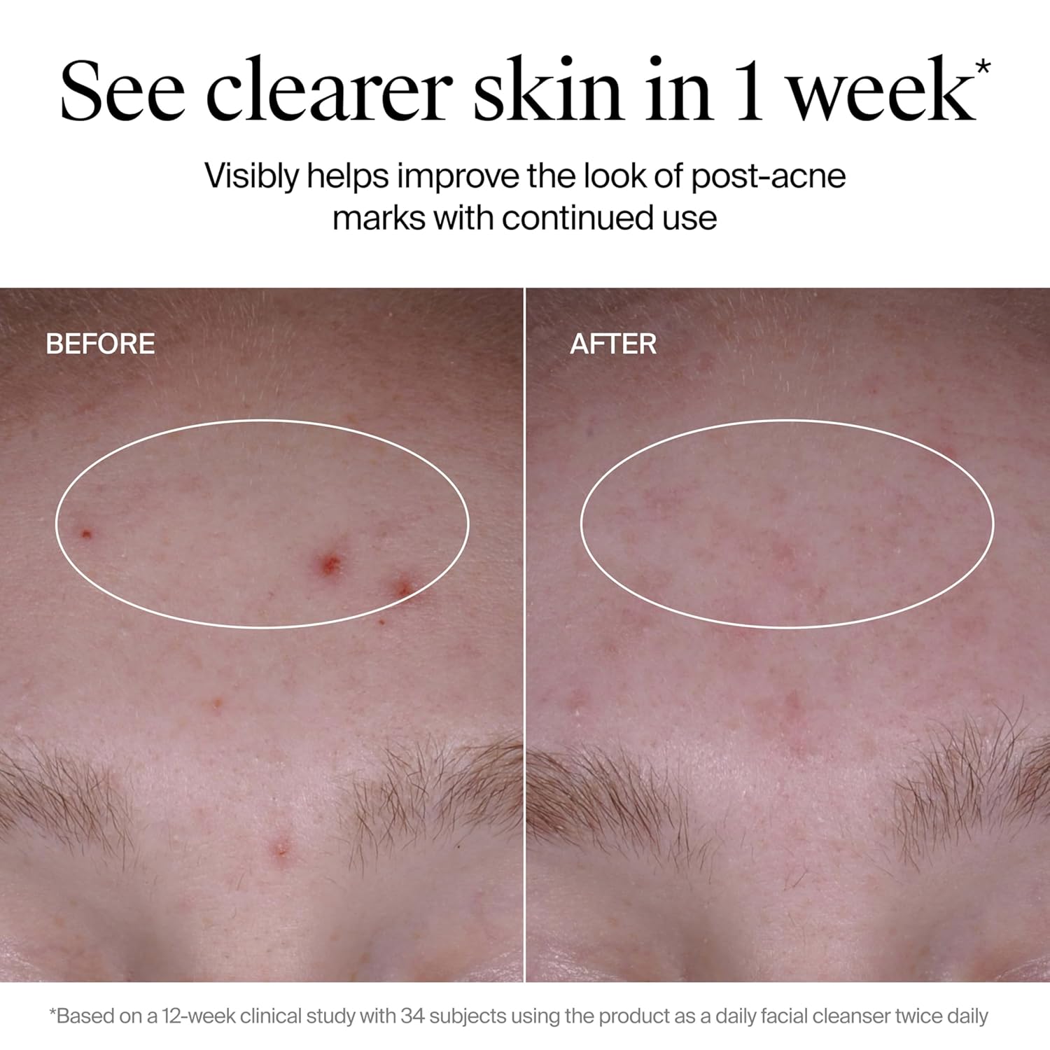 Neutrogena Evenly Clear Acne Cleanser with 2% Salicylic Acid & 2% PHA Exfoliant, Gentle Foaming Face Wash Clears Clogged Pores & Blackheads While Visibly Fading Look of Post-Acne Marks, 9.1 fl. oz