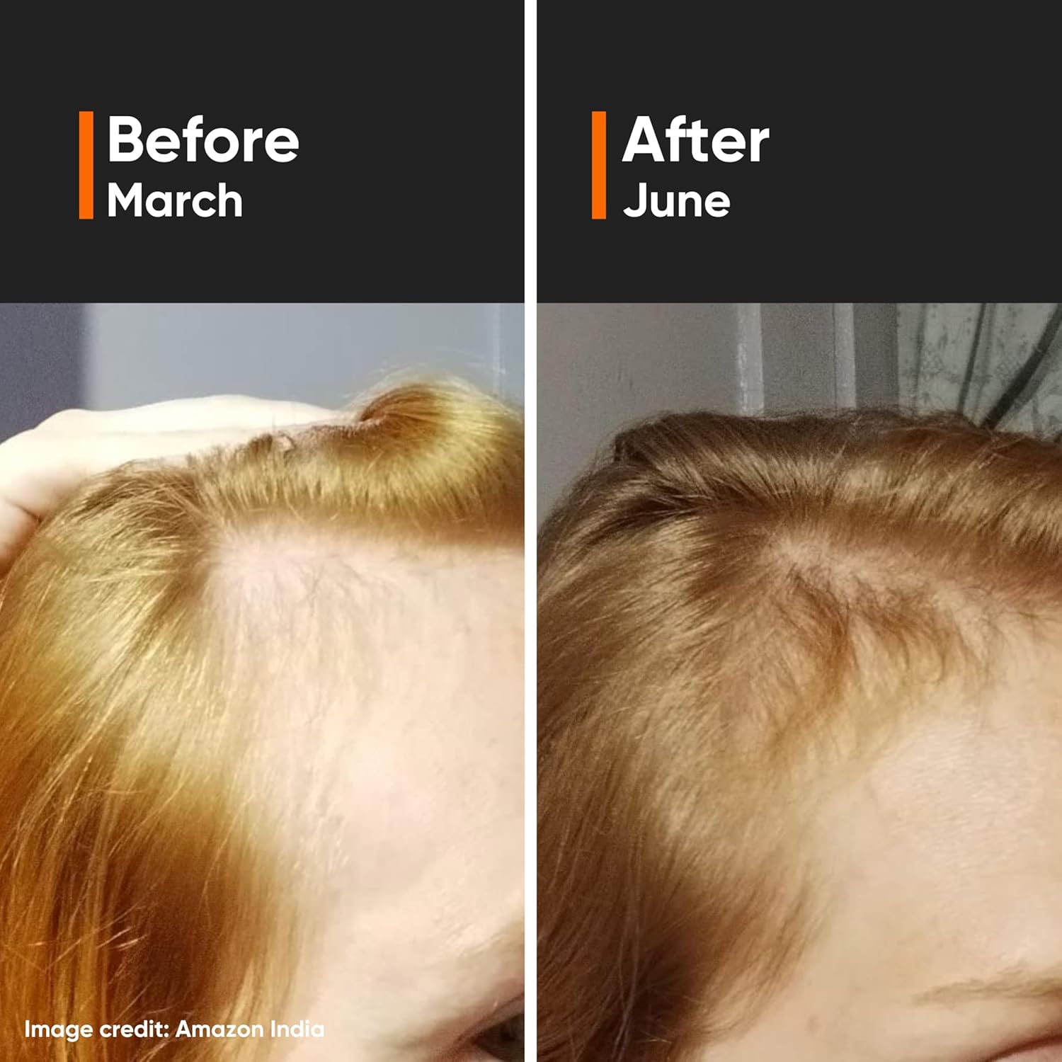 Minimalist Hair Density Serum 18% | Hair Growth Serum| Procapil, Capixyl, Redensyl, Anagain & Baicapil | Hair Fall Control & Hair Thickening | Women & Men | 30 ml | 18% Hair Growth Actives