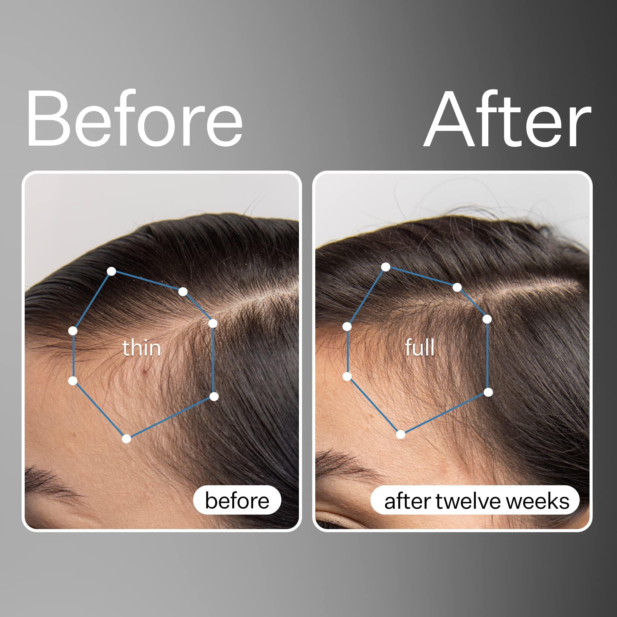Act+ Acre Cold Processed Stem Cell Scalp Serum | For Thicker, Fuller Looking Hair | Apple Stem Cells, Bamboo Extract, Aloe Vera | Strengthen, Hydrate, Reduce Shedding | Vegan, Color Safe | 2.2 Fl Oz