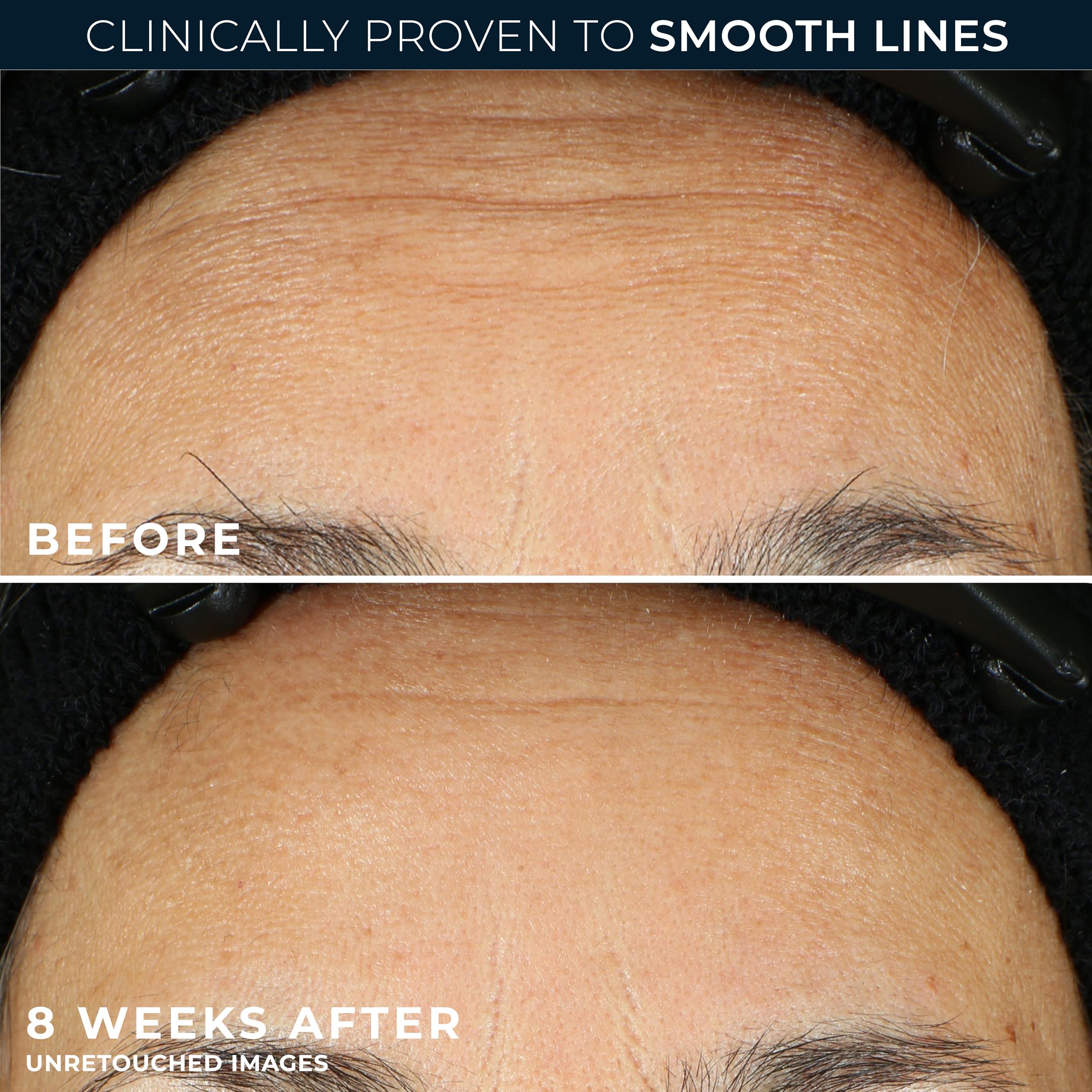 RoC Retinol Correxion Line Smoothing Eye Cream | For Wrinkles, Dark Circles & Puffy Eyes | 15 ml
