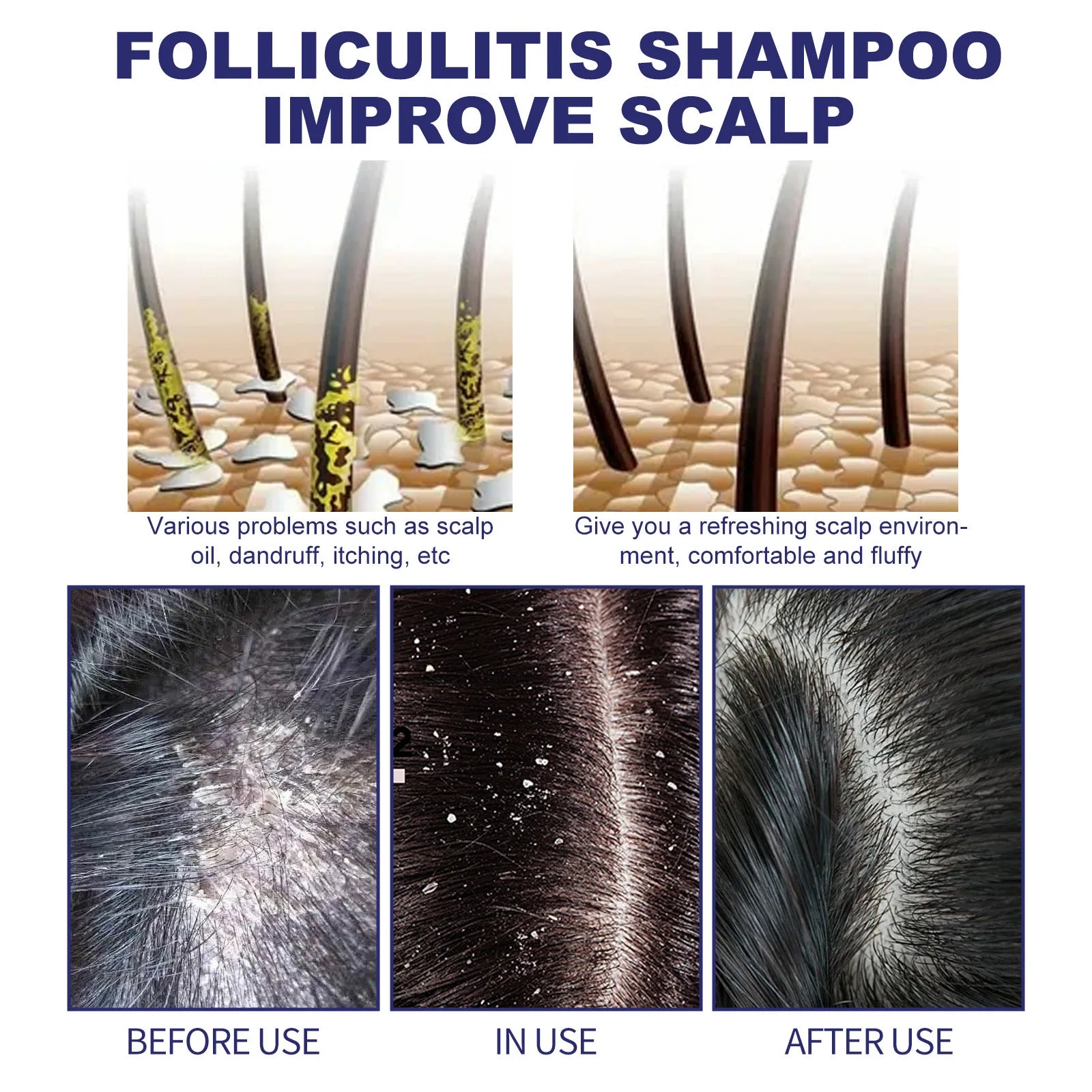 Folliculitis Shampoo Hair Loss Prevention Deep Scalp Cleansing Strengthening Hair Thickening Care Shampoo