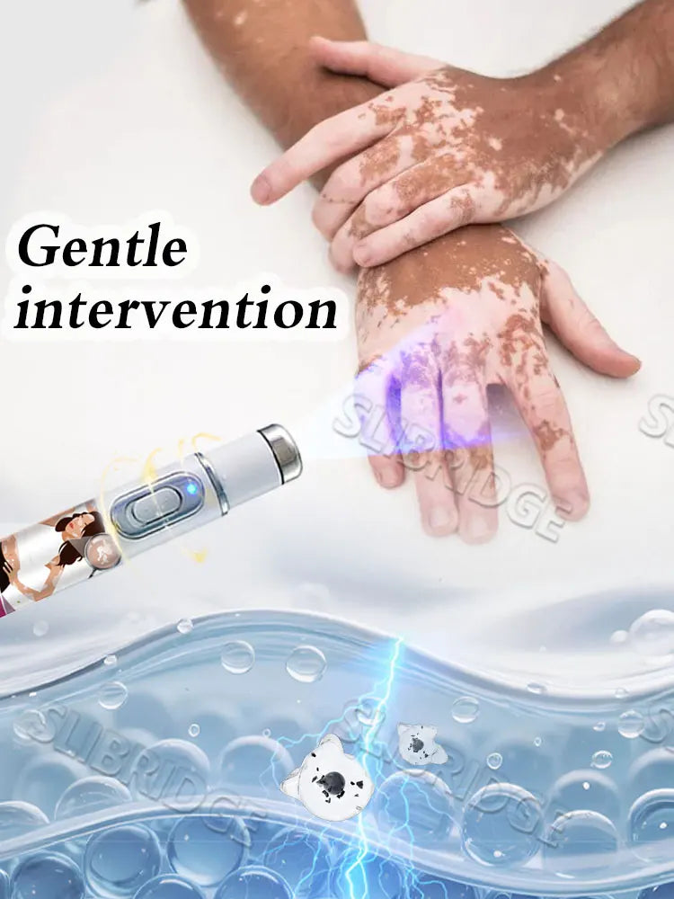 Blue light pen quickly removes vitiligo, a best-selling vitiligo care tool. Halalzen