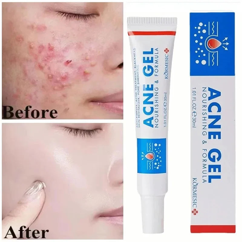 Effective Acne Removal Cream Anti-Acne Repair Redness Pimple Spots Gel Deep Cleaning Pore Oil Control Moisturizing Skin Care 30g