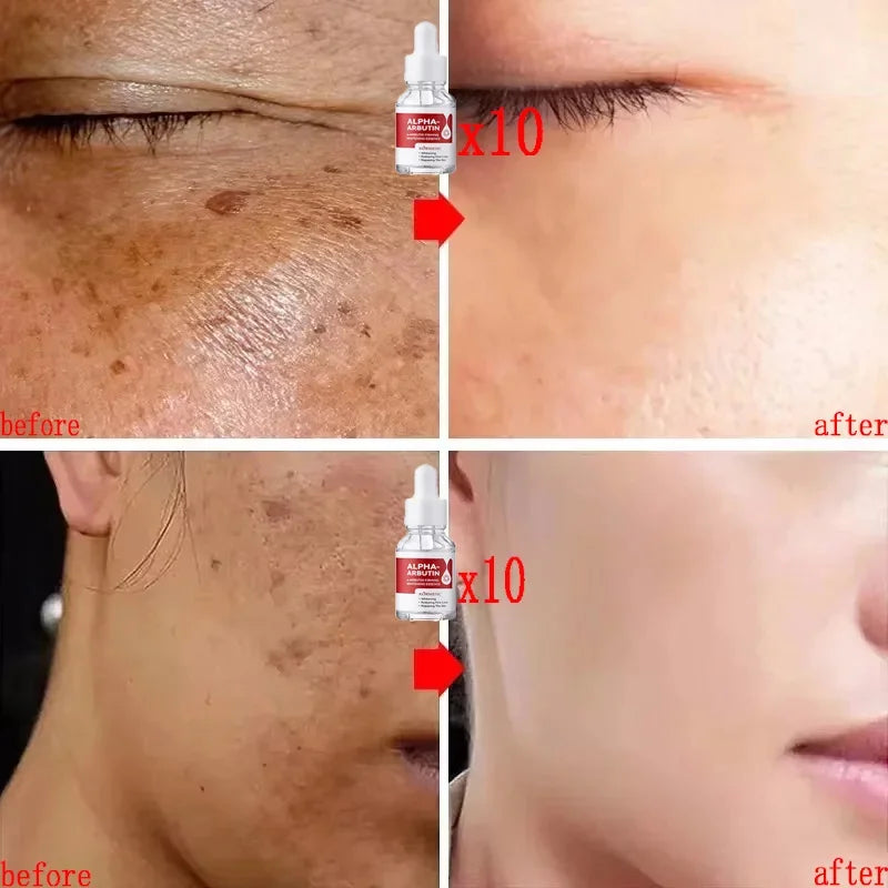 Powerful Dark Spots Remover Whitening Serum Face Freckle Melanin Correcting Anti Pigmentation Brighten Skin Beauty Care Essence