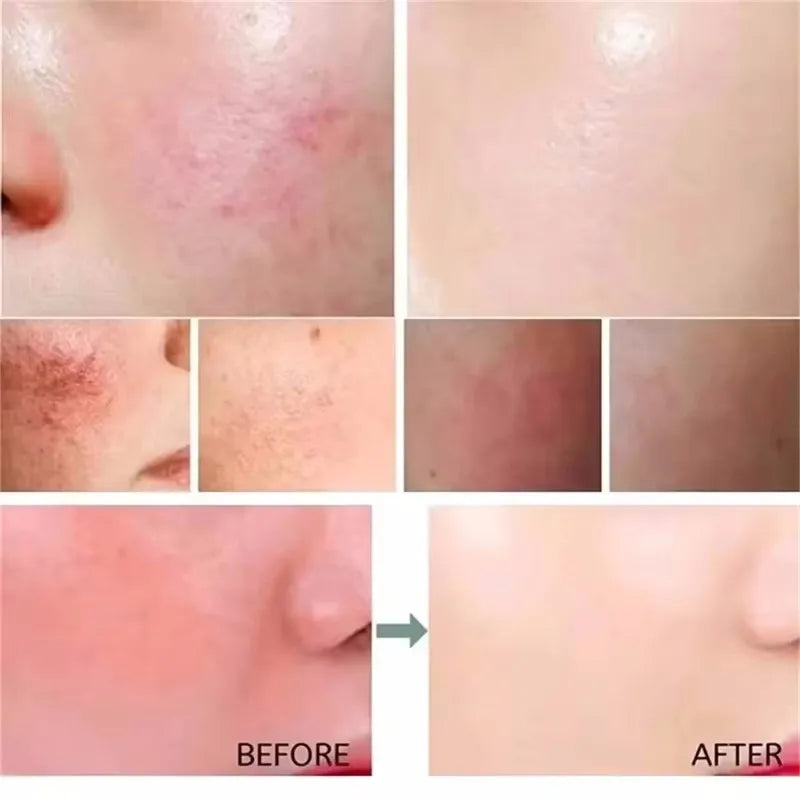 Facial Redness Repair Serum Improve Sensitive Skin Dryness Moisturizer Hydrating Sooth Lotion Removal Rosacea Korean Cosmetics Halalzen