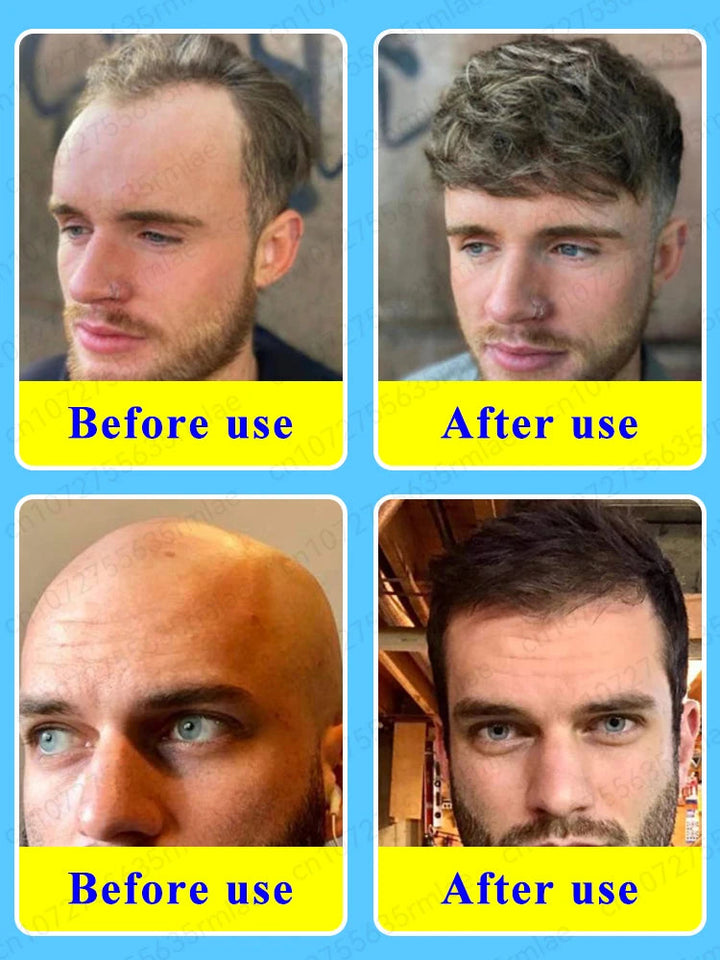 Grow cool hair secretly and surprise everyone. Say goodbye to baldness and hair loss now HALALZEN