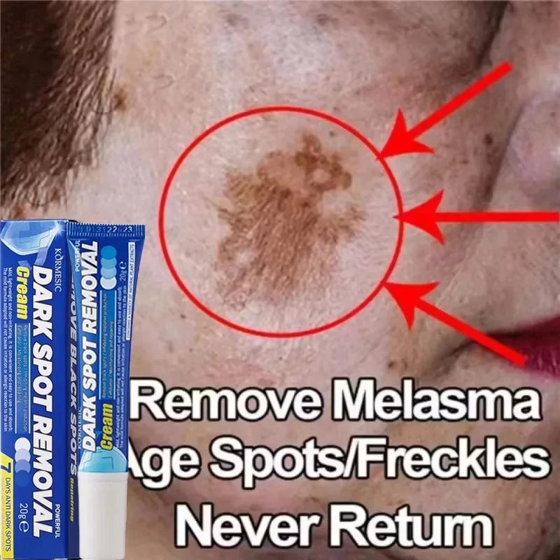 Effective Whitening Freckles Face Cream Remove Melasma Dark Spots Fade Pigmentation Acne Scars Moisturizing Brighten Beauty Care