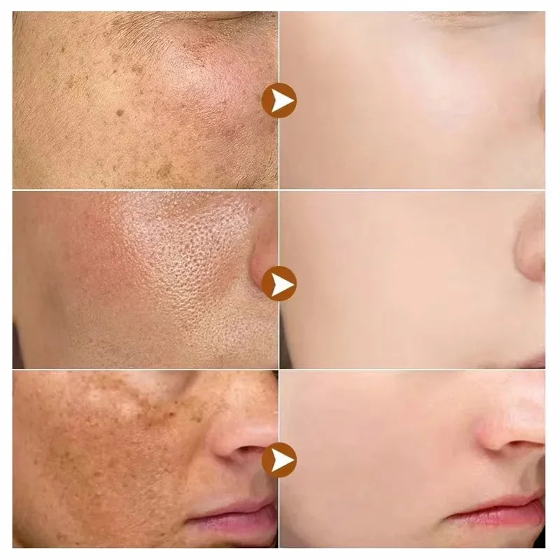 Powerful Dark Spots Remover Whitening Serum Face Freckle Melanin Correcting Anti Pigmentation Brighten Skin Beauty Care Essence