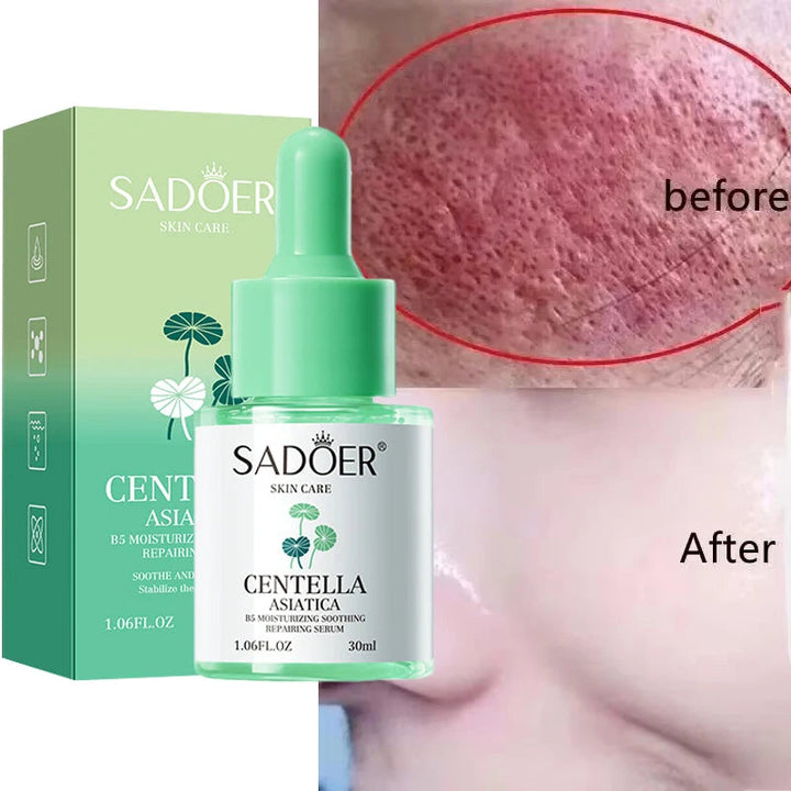 Facial Redness Repair Serum Improve Sensitive Skin Dryness Moisturizer Hydrating Sooth Lotion Removal Rosacea Korean Cosmetics Halalzen