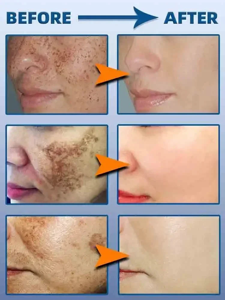 Dark Spot Remover for Face Removing Freckle target hyperpigmentation  age spots sun spot Whitening MOISTURIZING skin beauty care