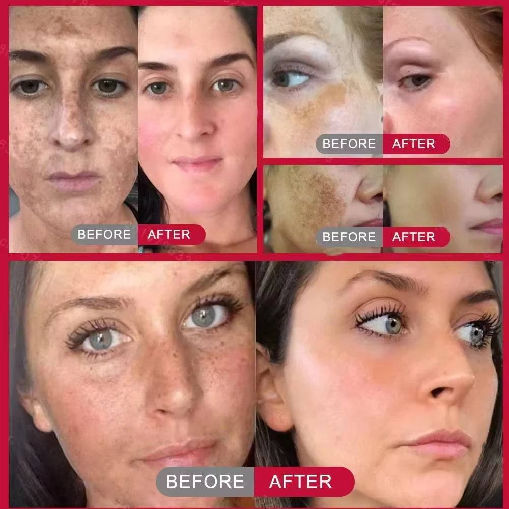 Kojic Acid Niacinamide Whitening Serum Dark Spot Remover Brightening Cream Freckle Mask Fade Acne Scars Melasma Dull Skin