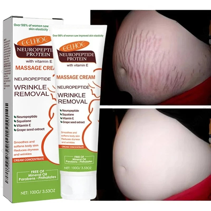 100g Stretch Marks Permanent Removal Cream Maternity Pregnant Women Pregnancy Anti-Winkle Smooth Repair Firming Skin Body Care