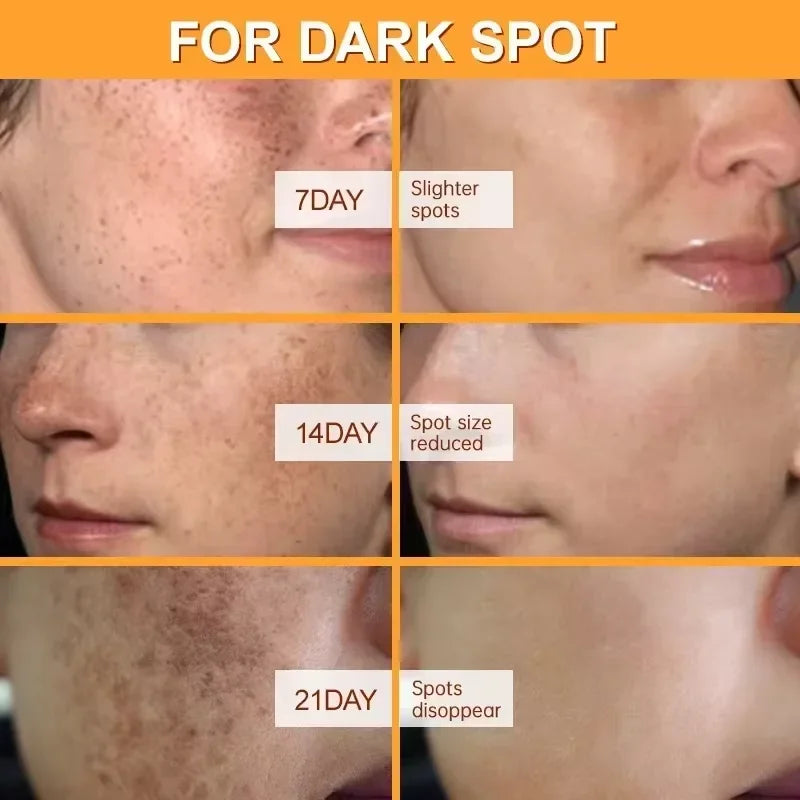 Whitening Freckles Face Cream Removal Melasma Dark Spots Corrector Lighten Melanin Pigmentation Brighten Anti-Aging Beauty Care Halalzen