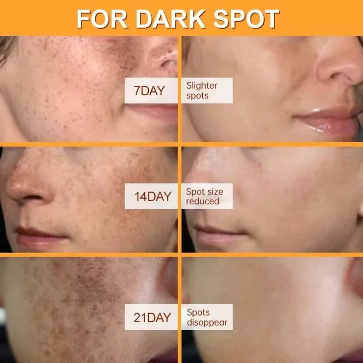 Whitening Freckles Face Cream Removal Melasma Dark Spots Corrector Lighten Melanin Pigmentation Brighten Anti-Aging Beauty Care Halalzen