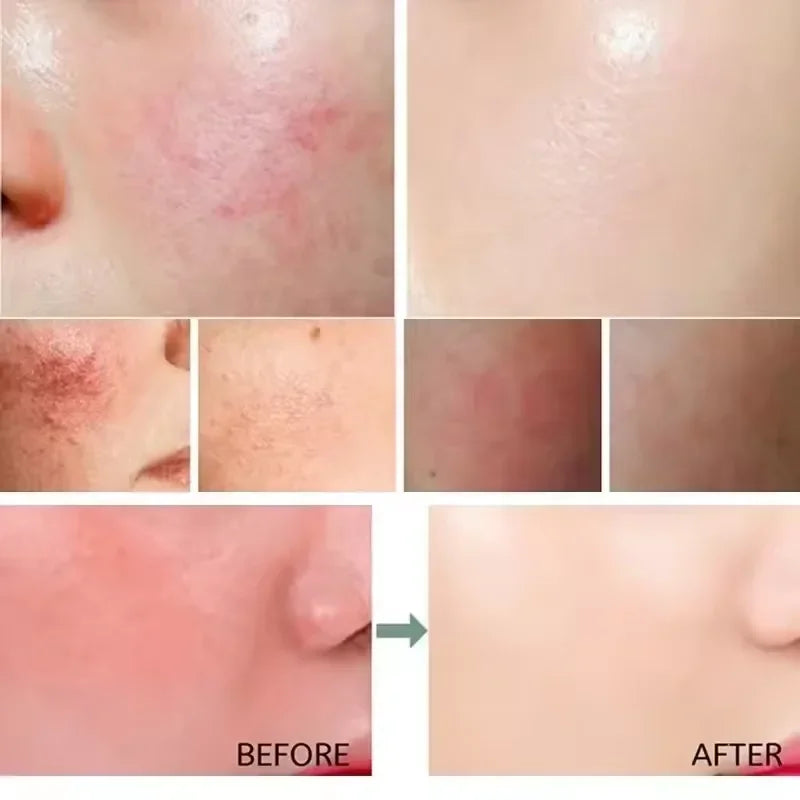 Facial Redness Repair Cream Improve Sensitive Skin Dryness Moisturizer Hydrating Sooth Lotion Removal Rosacea Korean Cosmetics Halalzen