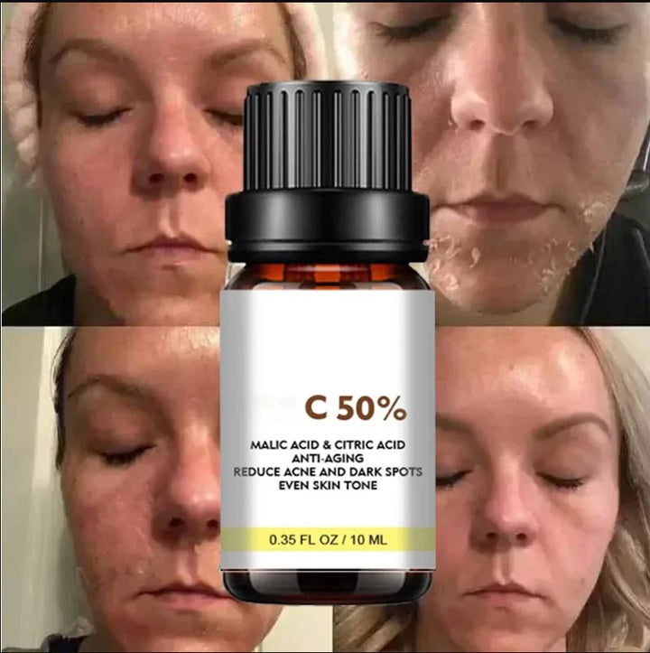 Dilute melanin, acne, 50% TCA, high-quality chemical exfoliation, acidic skin beauty care