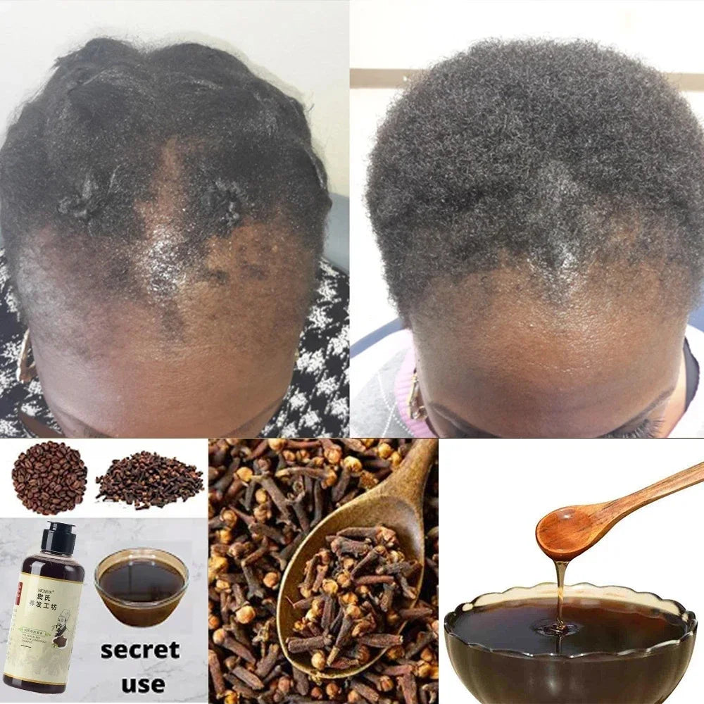 300ml Africa Women Traction Alopecia Treatment Hair Growth Product for Men Shampoo Hair Loss Treatment Get Rid of Wigs
