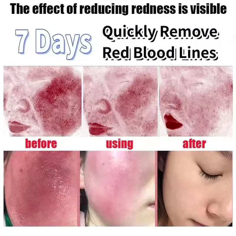 Facial Redness Repair Cream Improve Sensitive Skin Dryness Moisturizer Hydrating Sooth Lotion Removal Rosacea Korean Cosmetics Halalzen