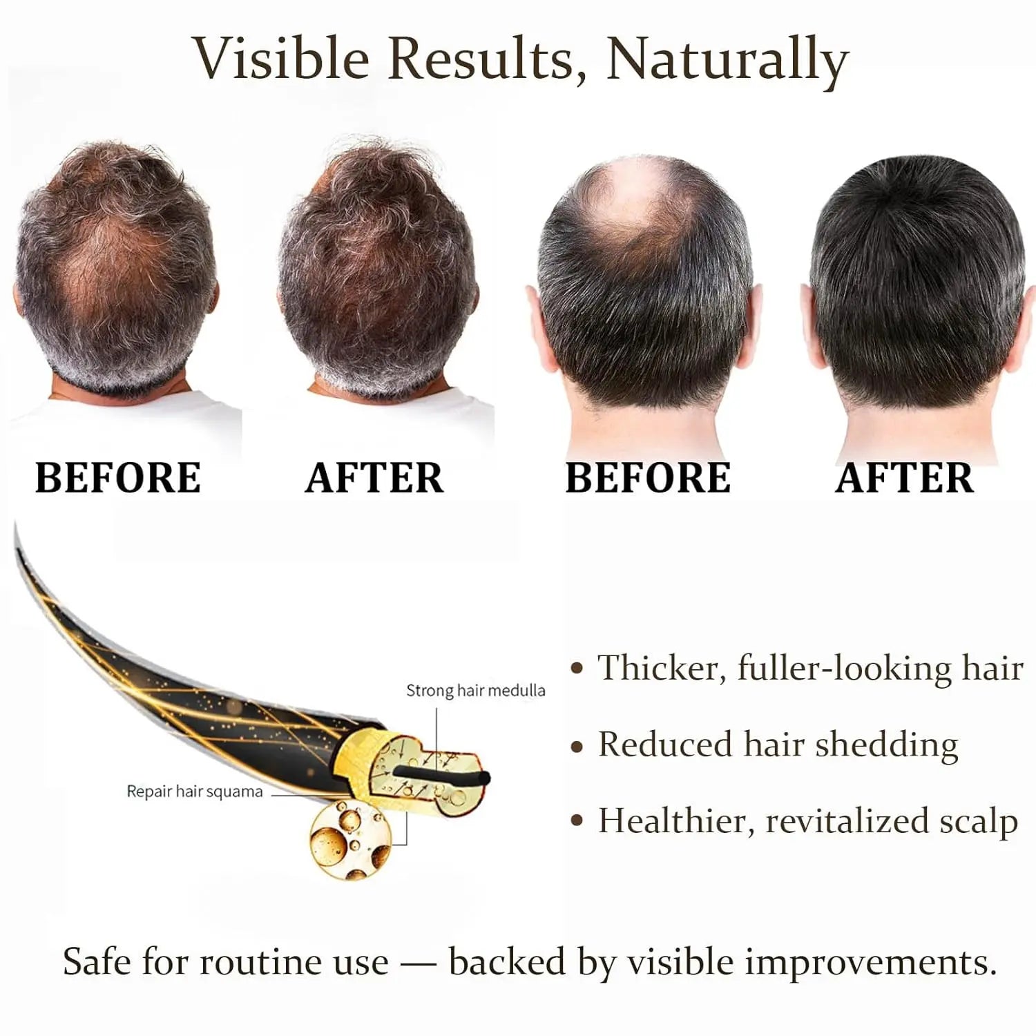 0.25mm Scalp Micro‑Needle Roller Set with 8×5ml Ampoules Nourish Follicles Reduce Loss & Breakage Boost Scalp Density