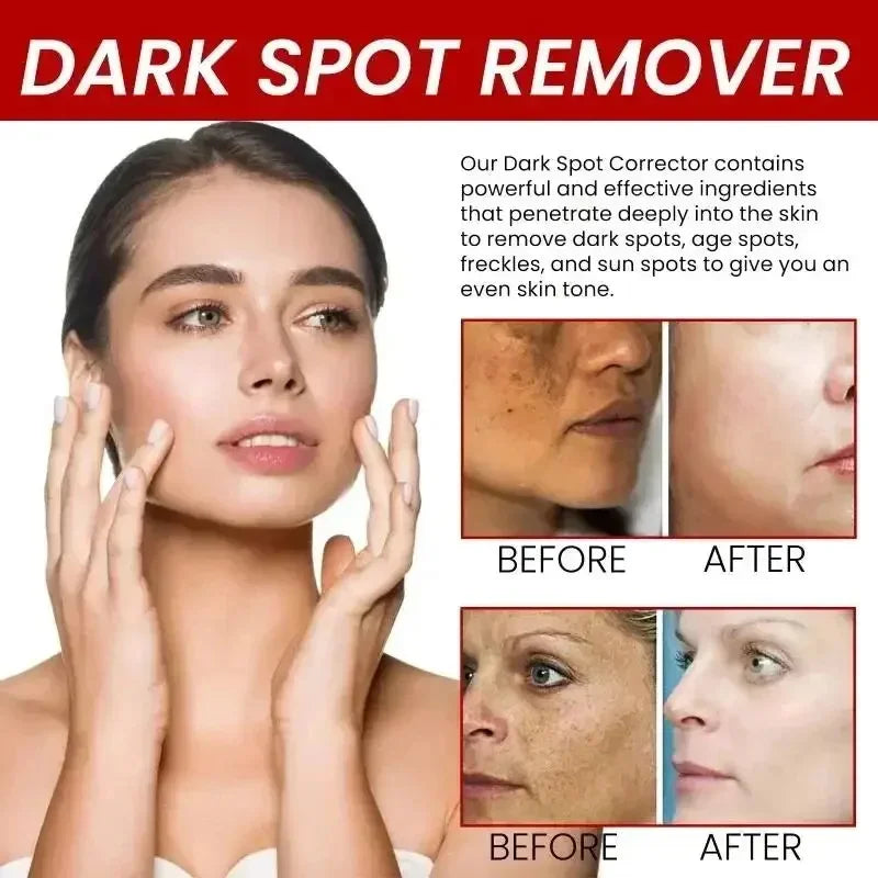 Powerful Spot-Removing Whiten Cream Brighten Skin Fast Eliminates Melanin Pigmentation Melasma Dark Spots Korean Face Skin Care