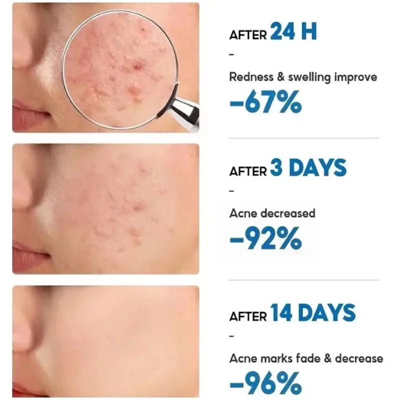Effective Acne Removal Cream Anti-Acne Repair Redness Pimple Spots Gel Deep Cleaning Pore Oil Control Moisturizing Skin Care 30g