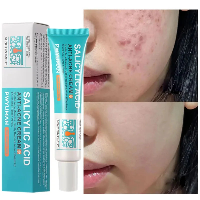 Salicylic Acid Acne Treatment Cream Repair Pimple Spots Deep Cleaning Pore Shrinking Anti-acne Oil Control Moisturizer Skin Care