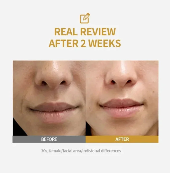 Kojic Acid Freckle Removing Whitening Essence Fade Pigmentation Melasma Dark Spots Corrector Repair Serum Korean Skin Care