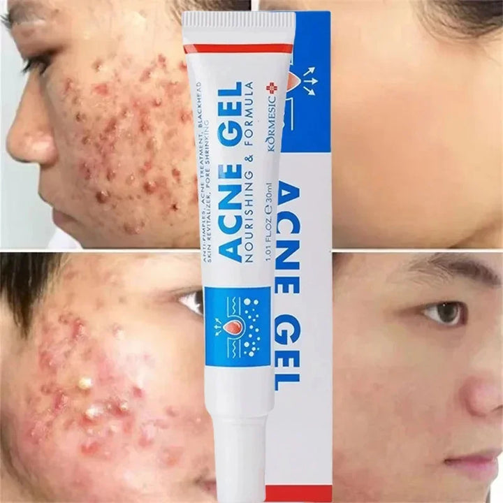 Effective Acne Removal Cream Anti-Acne Repair Redness Pimple Spots Gel Deep Cleaning Pore Oil Control Moisturizing Skin Care 30g