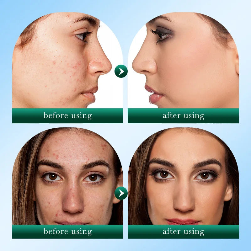 SADOER Tea Tree Acne Removal Facial Cleanser Moisturizing Anti-aing Anti Acne Deep Cleansing Face Wash Foam Cleanser Skin Care Halalzen